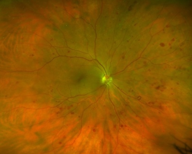 רשתית בעין ימין של מטופל עם סכרת. ניתן להבחין במוקדי דימום רבים, שנגרמו כתוצאה ממחלת הסוכרת.